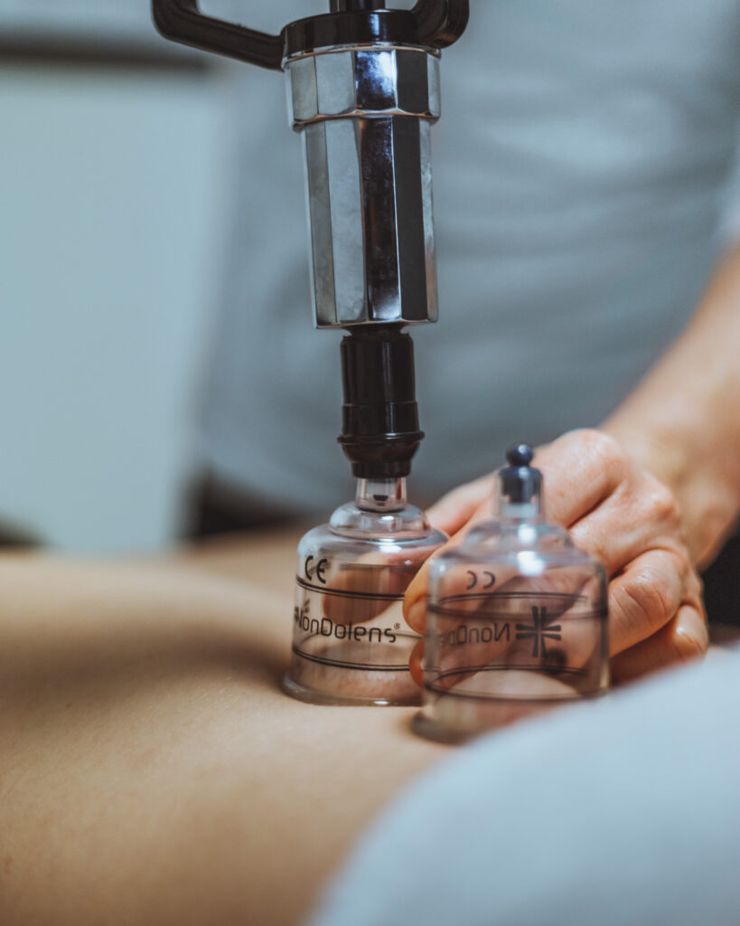 Cupping giver smertelindring