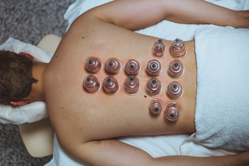 Cupping
