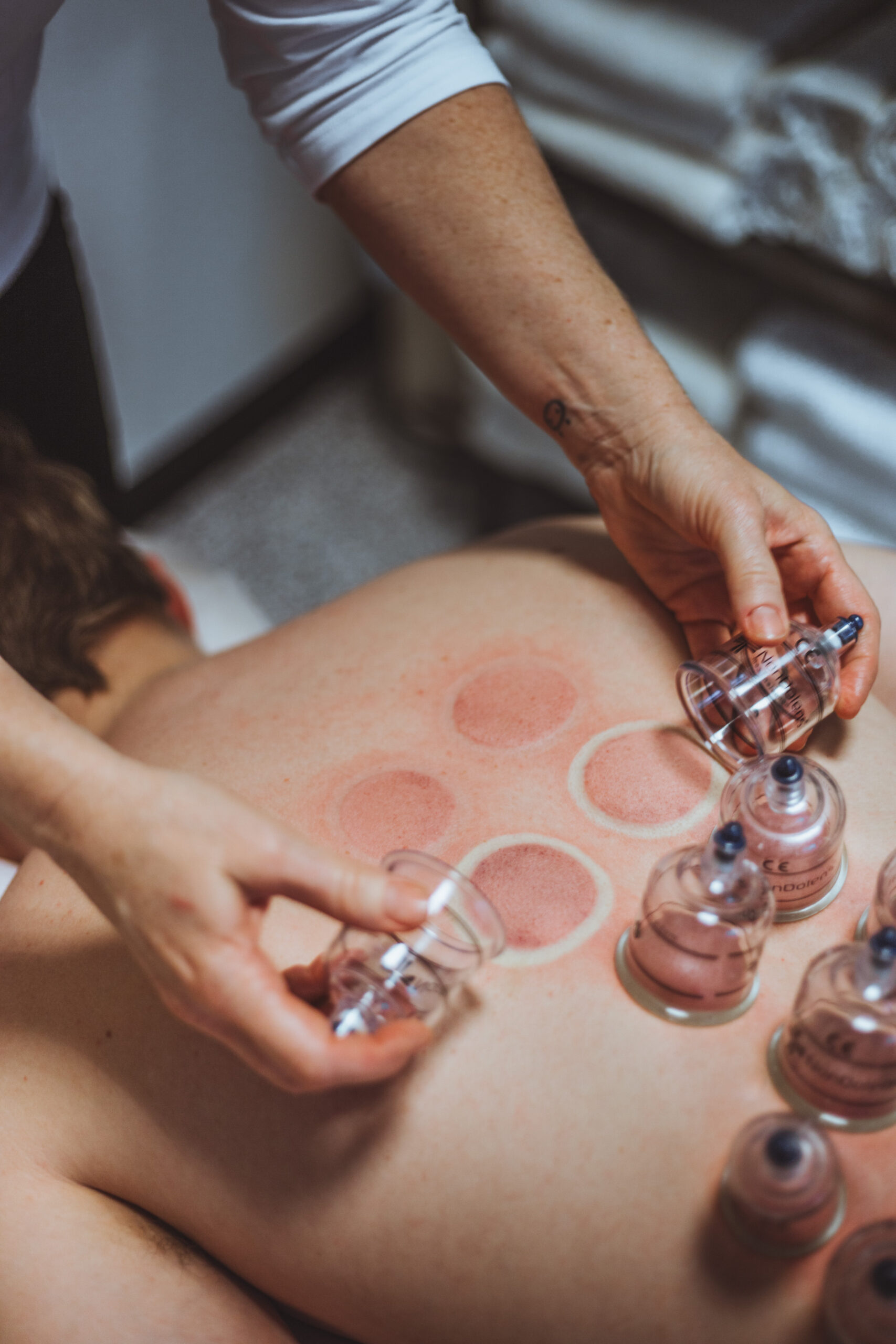 Cupping for lændesmerter